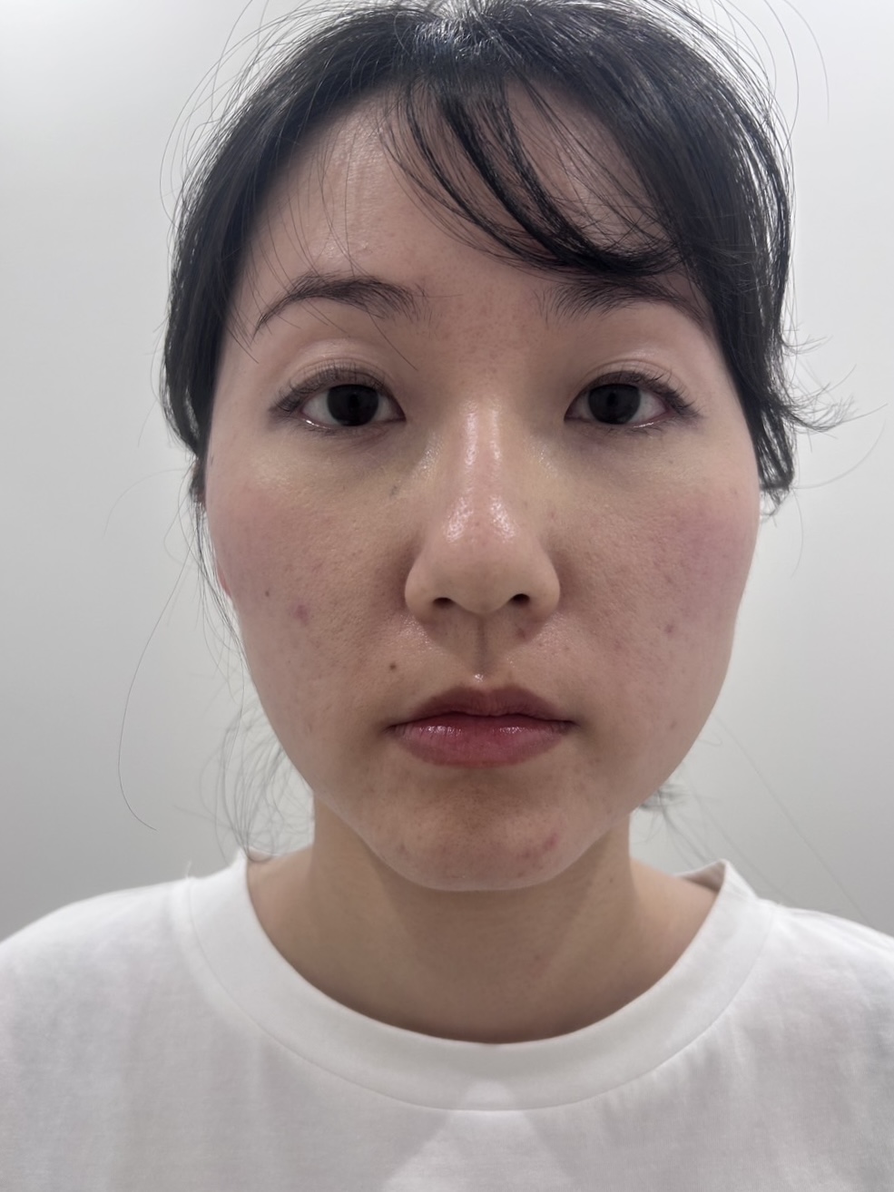 AFTER - 目元とフェイスラインが整い明るい印象へ