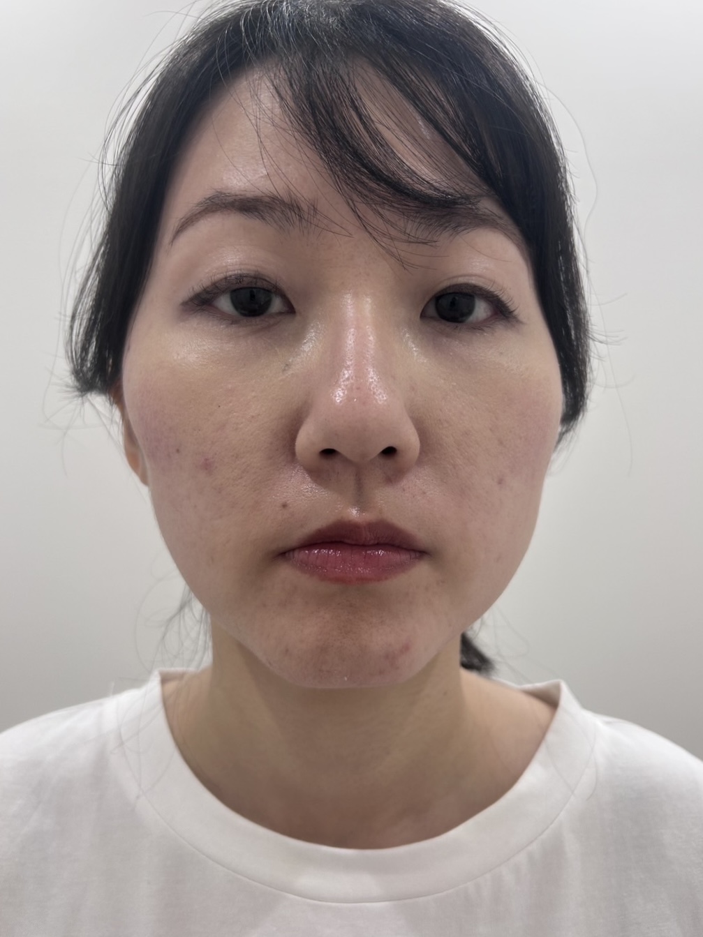 BEFORE - 目元とフェイスラインが整い明るい印象へ